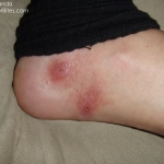 Two red bites on foot