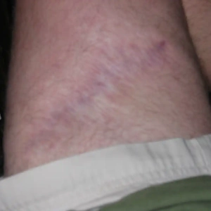 Brown recluse spider bite on leg months after healing.