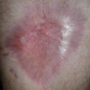 Brown recluse spider bite on leg months after being bitten.