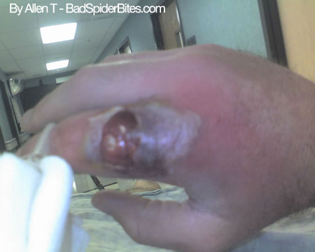 Allens bite on finger picture 2