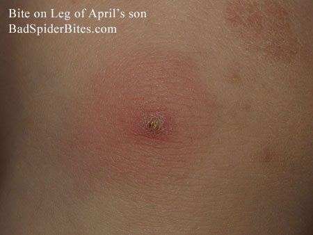 Bites on leg