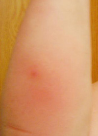Red infected bite on Karen's arm before treatment