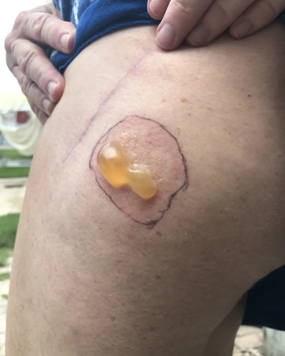 Bad reaction to tick showing lyme disease and blister inside red circle.