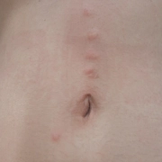 Bed bug bites are shown on this woman's belly.