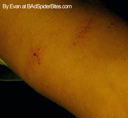 Evan and bite lines on arm