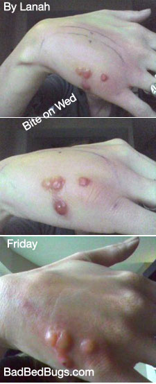 Four swollen red bites on Lanah's hand from bed bugs