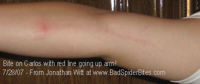 Spider Bite w Red Line going up arm