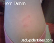 Bite from Tammi