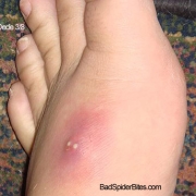 Spider bite on foot that led to staph infection