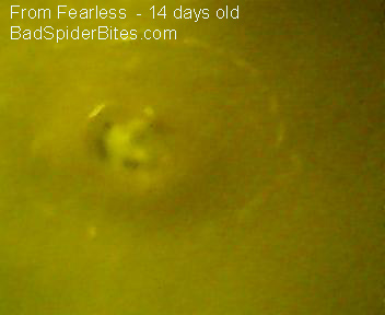 Healing bite on the back of Fearless's leg after antibiotics