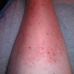 bites on casey's leg 2