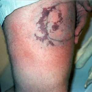 Brown recluse spider bite on leg 1 day after being bitten.