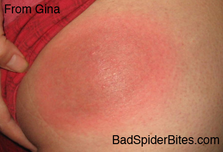 Large solid red circle around a small bite on Gina's thigh
