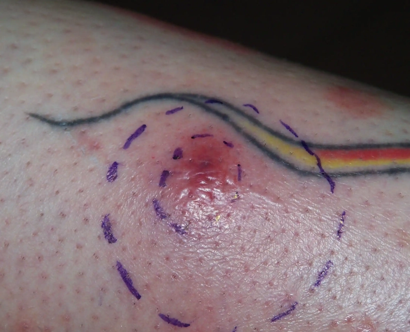 Hobo spider bite on arm shown red and swollen with lines around wound.