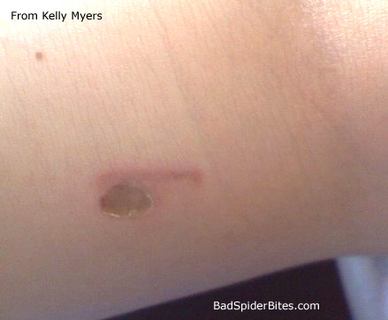 Kelly Myer's Bite