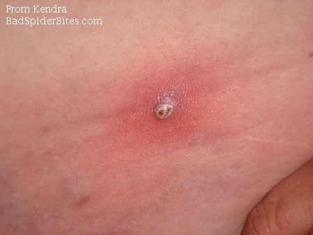 Small pimple-like bite on Kendra's stomach that became cellulitis