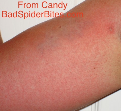 Bite on Candy's arm that triggered a severe systemic reaction
