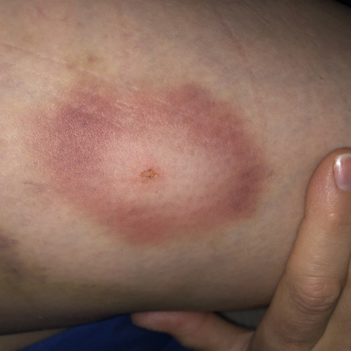 Lyme disease on the back of womans arm showing red ring.