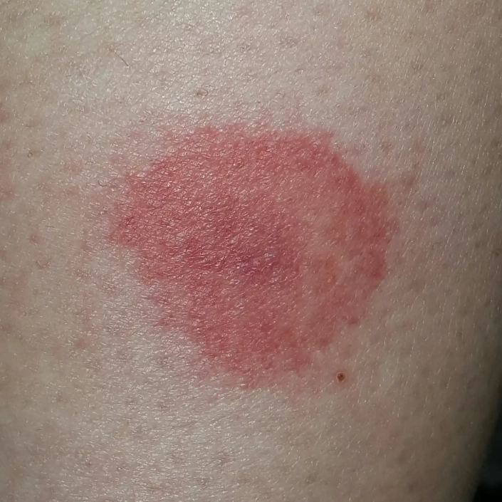 Lyme disease on a person's back from a tick showing red circle.