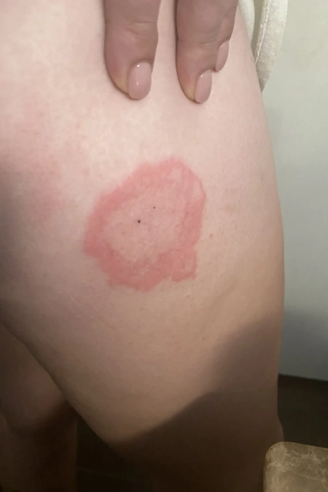 Lyme disease on leg showing red rings from a tick.