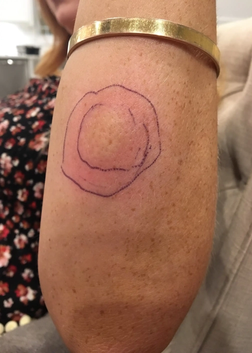 Lyme disease after a tick found on forearm with two red circles.