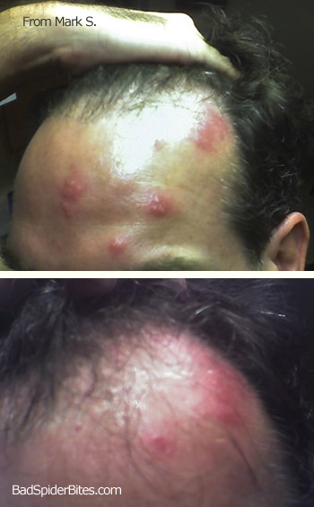 Marks Spider Bites on Head