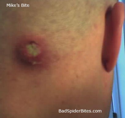 Mikes Spider Bite