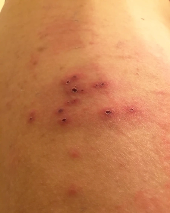 Red scabies bumps on arm some black