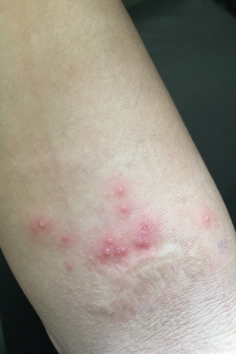 Scabies on the arm with red blisters