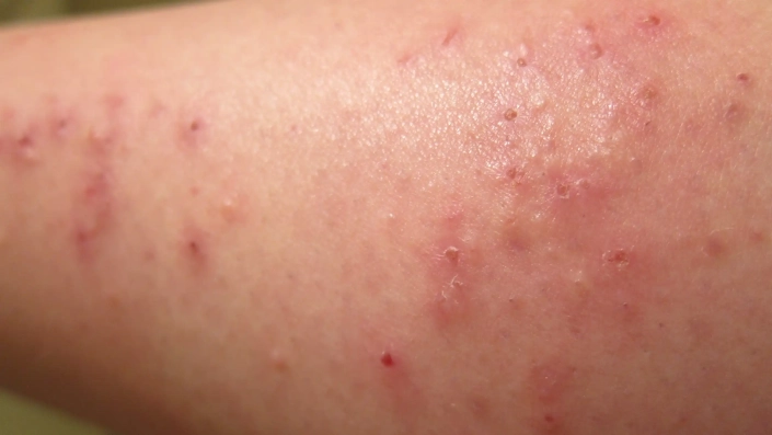 Close up of scabies on the arm showing red blisters