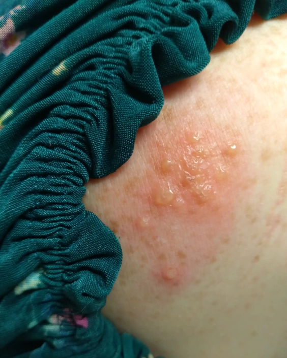 Scabies is shown on the neck of this woman