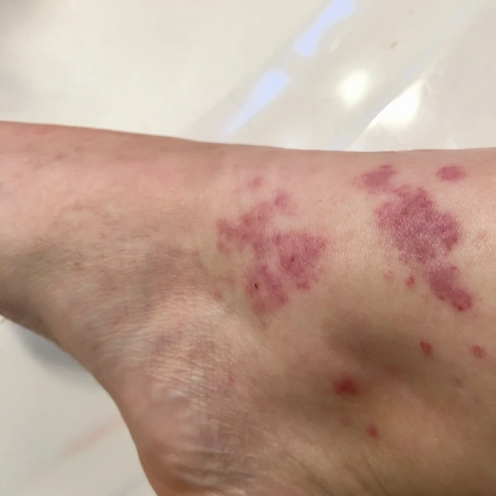 Closeup pictures of scabies shown on foot