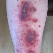Severe case of shingles on back of leg is red and swollen.