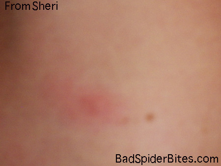 Red welts with white centers on Sheri's skin from oak itch mites