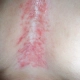 Shingles is shown on this woman's chest red and pimple like.