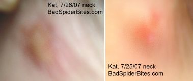 Spider Bite on Kat's Neck