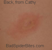 Spider Bite on Cathy's daughter
