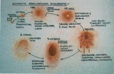 Spider Bite Cycle