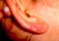 Spider Bite- Ear