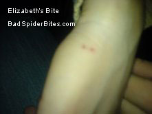 Spider Bite on Elizabeth's Arm