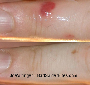 Spider bite on Joes finger