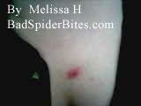 Spider bit on Melissa's chest