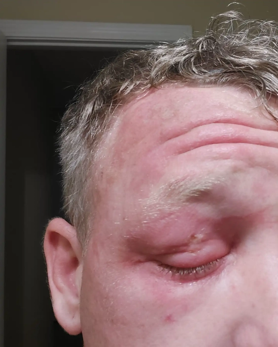 Spider bite on this mans eyelid is red and swollen