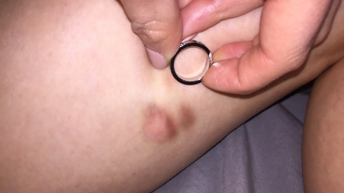Spider bite on leg compared to wedding ring