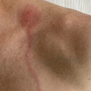 Red spider bite with line going towards the heart.