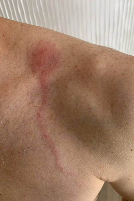 Red spider bite with line going towards the heart