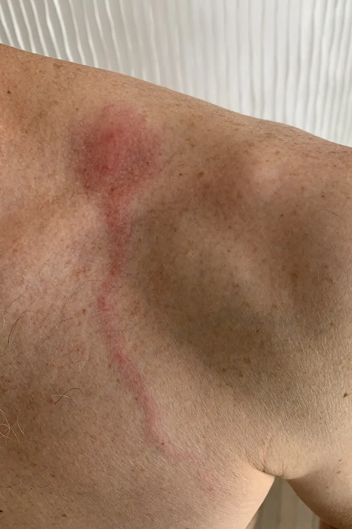 Spider Bite Pictures - What They Look Like, How To Treat Symptoms