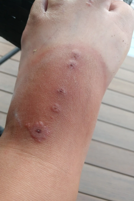 Spider bite on foot 5 bites shown