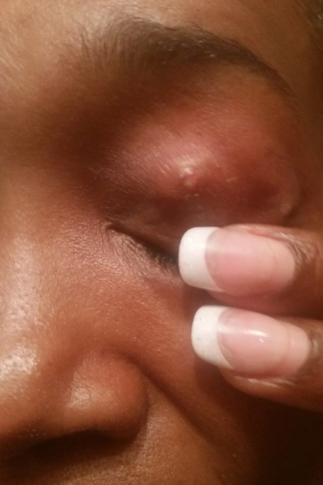 This woman has a spider bite on her eyelid