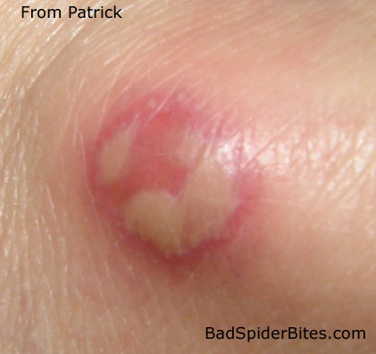 Spider Bite on Patrick's Ankle